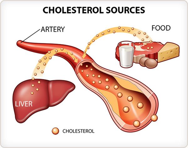 Повышение уровня холестерина в крови