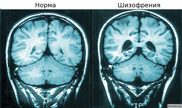 Желудочки мозга: норма и шизофрения
