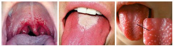 Симптомы скарлатины во рту и на языке