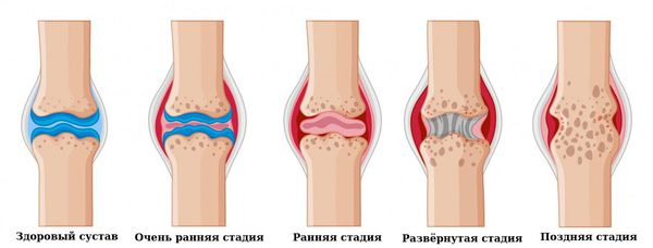 Клинические стадии ревматоидного артрита
