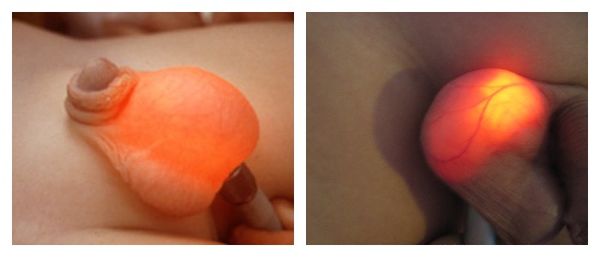 Диафаноскопия при водянке яичка Диафаноскопия при водянке яичка