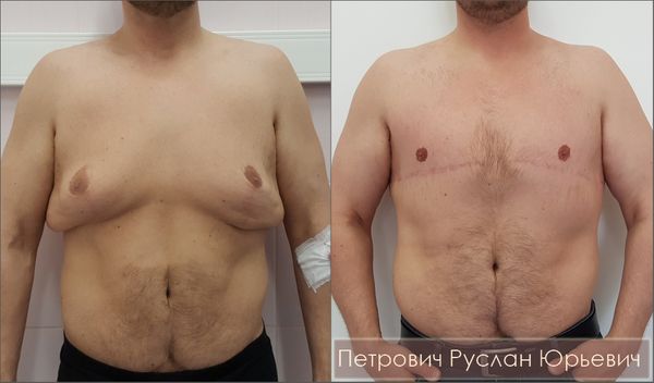 Ампутационная пластика груди при выраженной гинекомастии — результат операции через шесть месяцев Ампутационная пластика груди при выраженной гинекомастии — результат операции через шесть месяцев