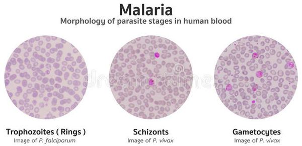 Классификация малярии