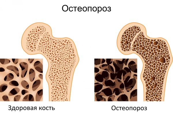 Что означает стадия консолидации при переломе