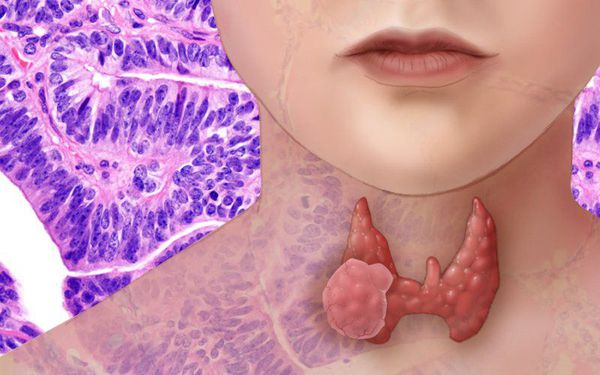 Как можно вылечить аденому щитовидной железы thumbnail