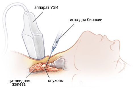 Аденома щитовидной железы лечен thumbnail