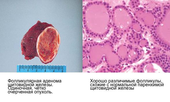 Малигнизация аденомы щитовидной железы thumbnail