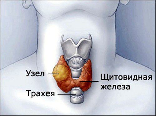 Узел щитовидной железы может сдавливать гортань