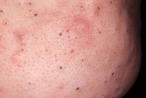 Акне заболевание кожи лица