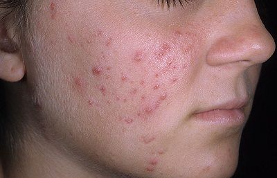 Акне заболевание кожи лица