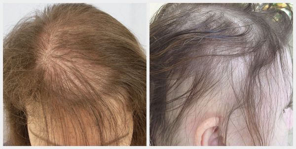 Как остановить андрогенное выпадение волос у женщин thumbnail