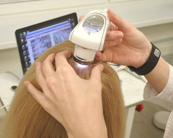 Как лечить андрогенное выпадение волос thumbnail