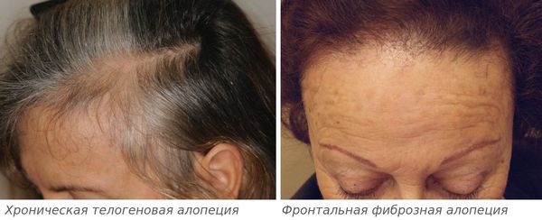 Выпадение волос по андрогенному типу у женщин thumbnail