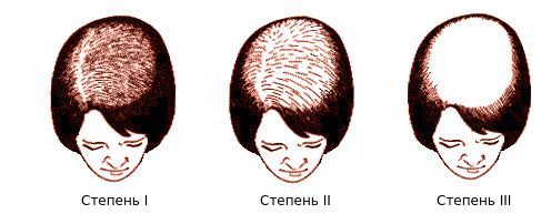 Что такое выпадение волос по андрогенному типу thumbnail