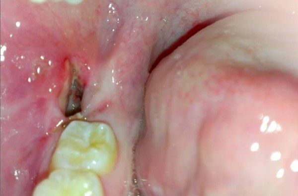 Альвеолит зуба причины лечение thumbnail