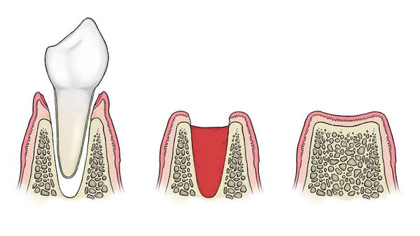 Нормальный процесс заживления после удаления зуба