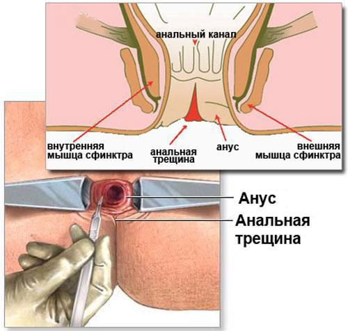 Трещина анального канала