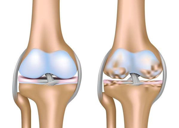 Схематическое изображение коленного сустава с нормальным хрящом (слева) и пораженным артрозом (справа)