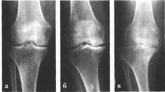 Рентгенограмма коленного сустава — гонартроз: а - I стадия, б - II стадия, в - III стадия