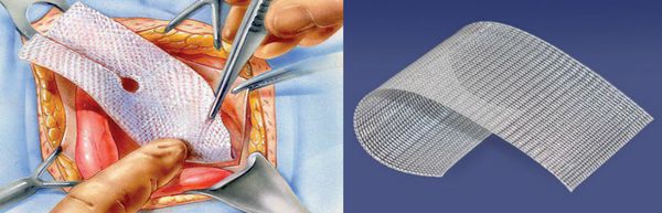 Метод Лихтенштейна с применением сетчатого импланта