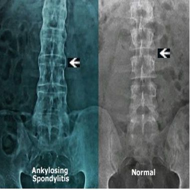 Анкилозирующий спондилоартрит и здоровый позвоночник на рентгенограмме