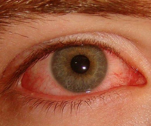 Болезни оболочки глаз при болезни бехтерева thumbnail