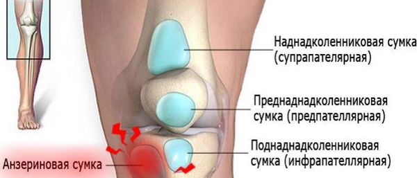 Воспаление коленный сустав сумка лечение thumbnail