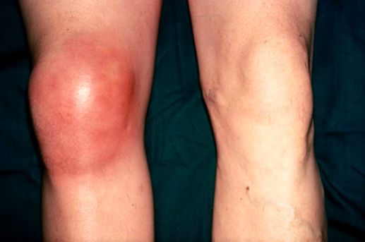 Разрыв синовиальной сумки коленного сустава лечение thumbnail