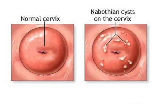 Эрозия шейки матки наботова киста