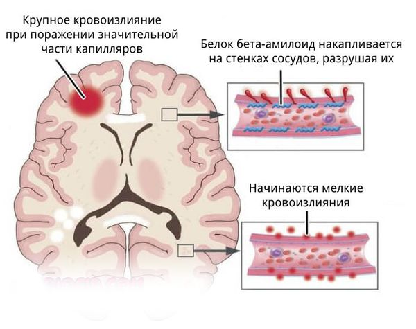 Гематома головного мозга лечение консервативное лечение thumbnail