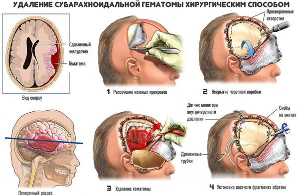 Гематома головы после ушиба симптомы и лечение thumbnail