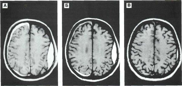 Ушиб головного мозга пластинчатая субдуральная гематома thumbnail