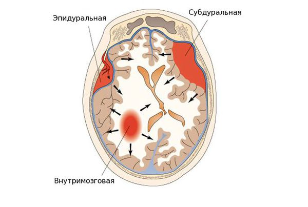 Гематома головного мозга после травмы лечение thumbnail