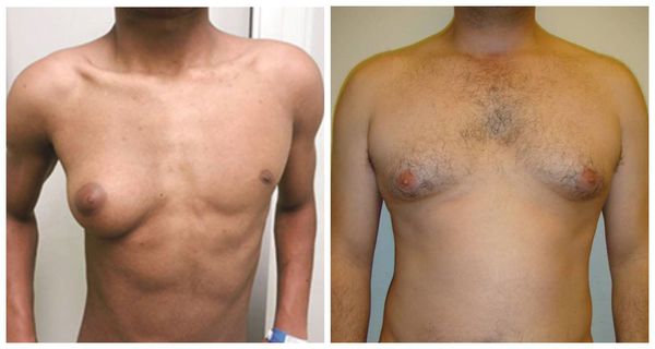 Лечение увеличение грудных желез у мужчин thumbnail