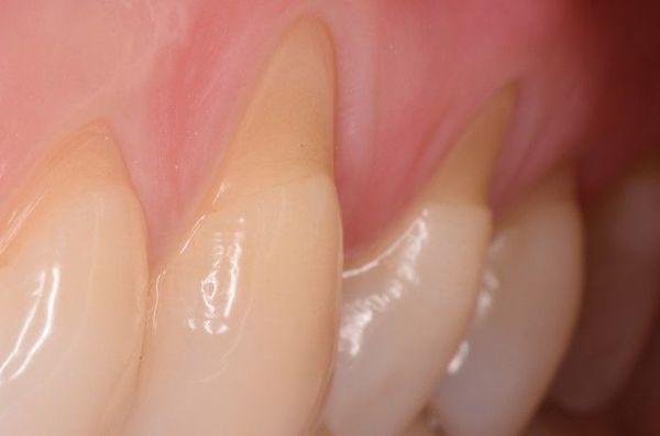 Профессиональное лечение гиперестезии зубов thumbnail