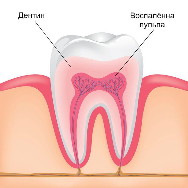 Жидкость для профилактики кариеса зубов для лечения гиперестезии зубов thumbnail