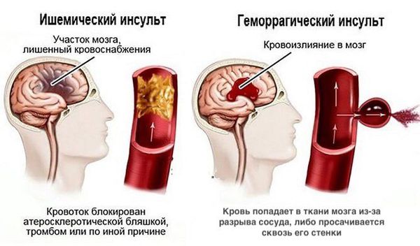 Ишемия головного мозга сильные головные боли thumbnail