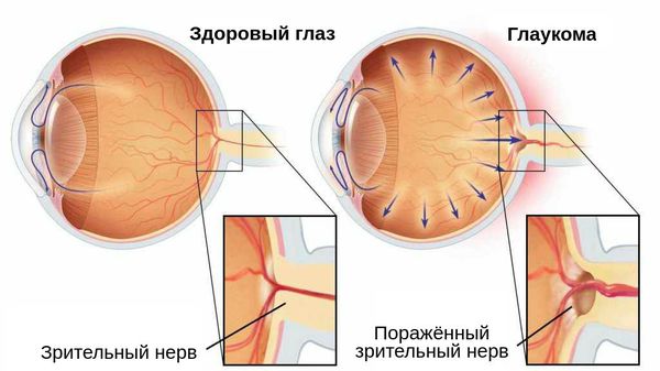 Поражённый зрительный нерв при глаукоме