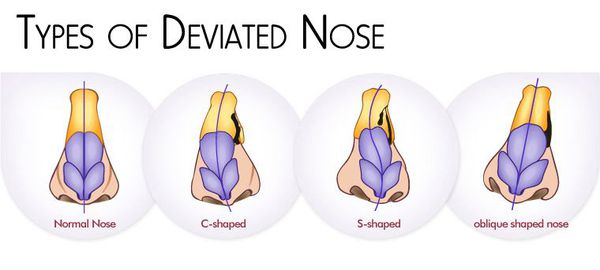 Типы искривления носа