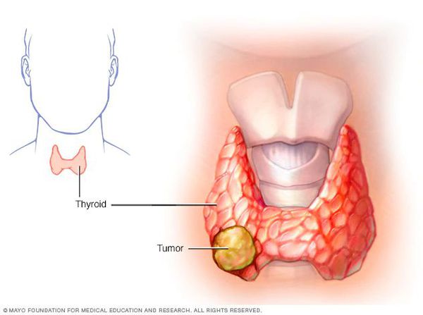 Опухолевый узел щитовидной железы