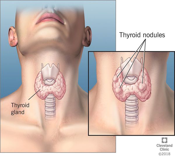 Фолликул щитовидной железы симптомы thumbnail