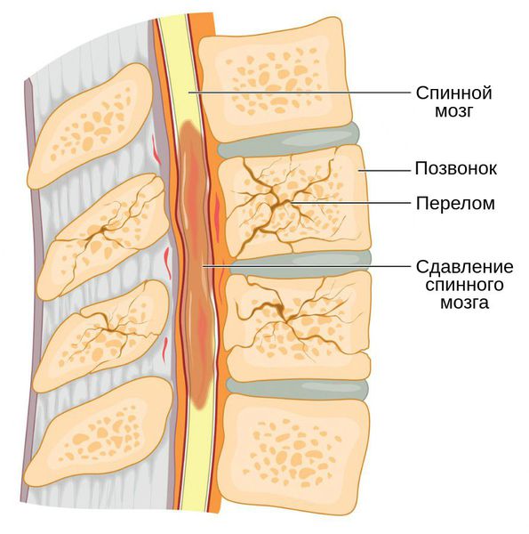 Лечение компрессионного перелома позвоночника саратов thumbnail