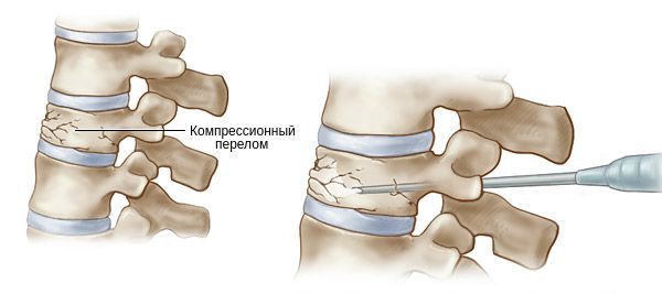 Позвоночник компрессионный перелом и его лечение thumbnail