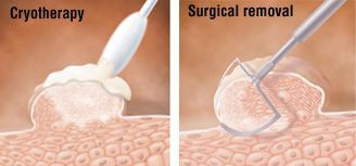 Криодеструкция аногенитальной бородавки и её удаление скальпелем