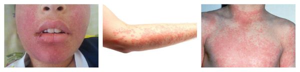 Аллергия на лекарства сыпь лечение thumbnail