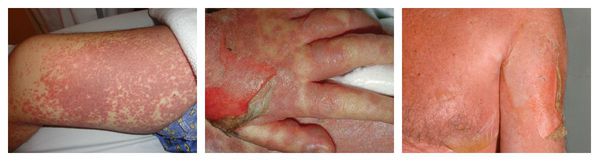 Лекарственная аллергия тип аллергической реакции thumbnail