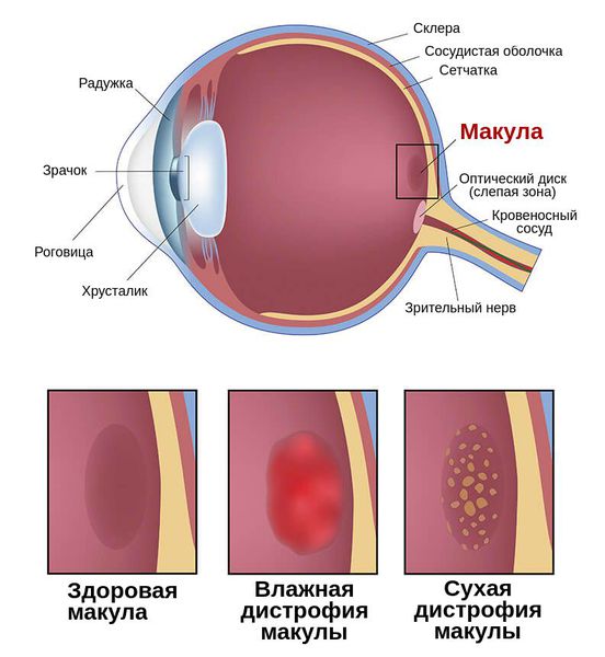Макула дистрофия сетчатки глаза можно ли ослепнуть thumbnail