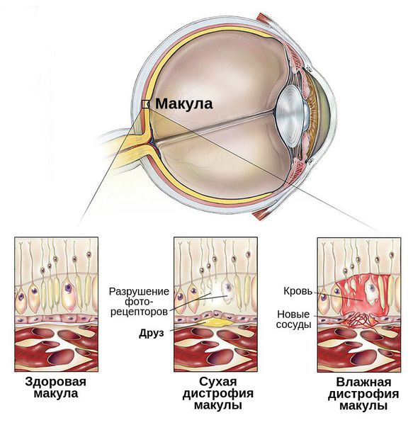 Заболевание глаз макулодистрофия лечение thumbnail