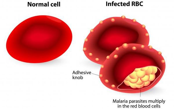 Синдром не характерный для малярии thumbnail