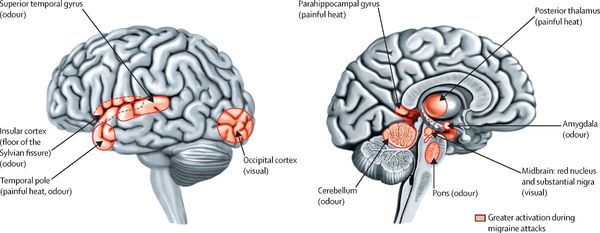Зоны головного мозга, активирующиеся во время мигрени